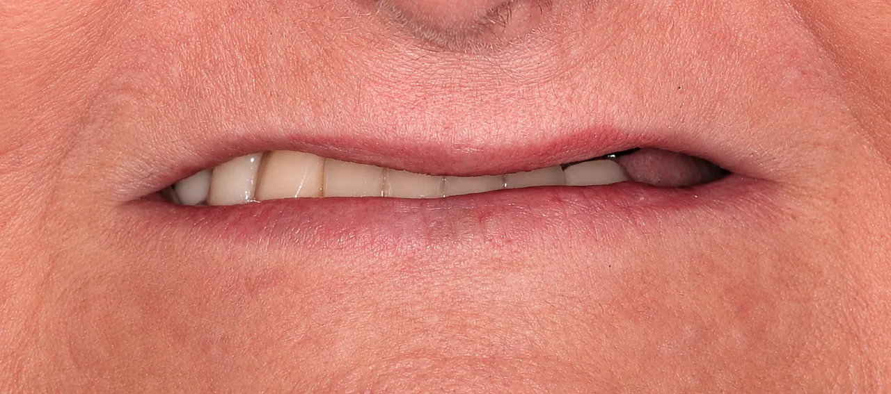 Antes - Caso 3 · Blanqueamiento dental